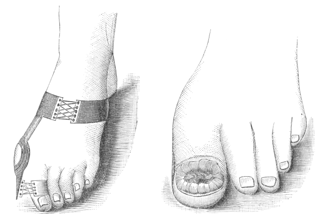 Schwarze und weiße Zeichnung eines Paares Füße, einer mit einem Verband und der andere mit einer sichtbaren Fraktur.