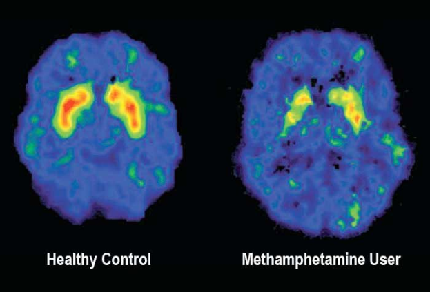 Zwei MRI-Gehirn-Scans nebeneinander, beschriftet mit "gesunder Kontroll" (links) und "Methamphetamin-Nutzer" (rechts), mit dem Text "Methamphetamin-Nutzer gegenüber gesunder Kontroll" unten.